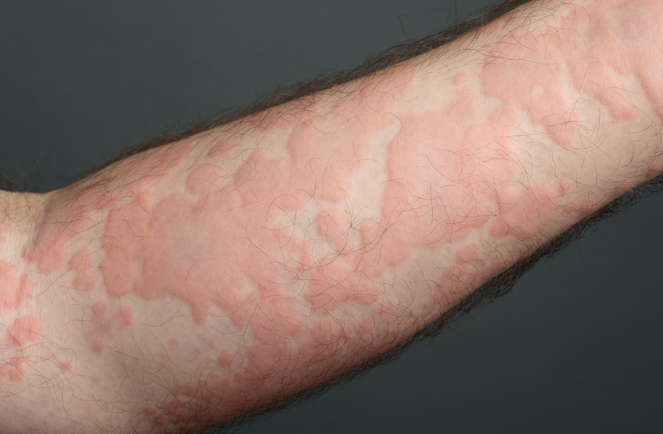 rash due to allergic reaction (XXXL)