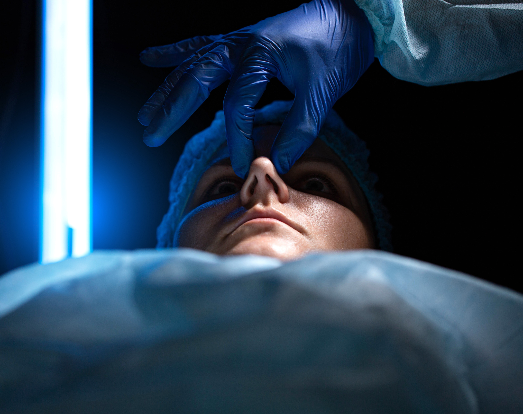 Correction of the Nasal Septum, Defects in the Shape of the Nose in the Female Patient. Surgical Intervention in Plastic Surgery Rhinoplasty and Septoplasty. Close-up