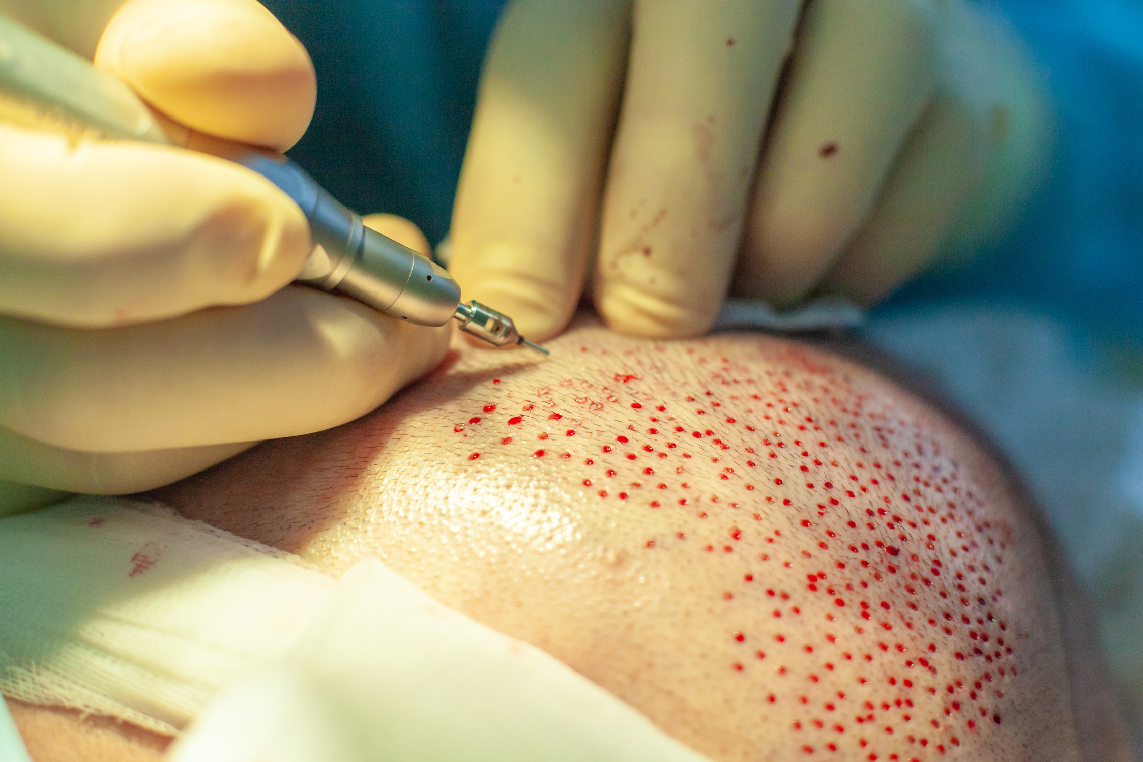 Patient's head close-up. Baldness treatment. Hair transplant. Surgeons in the operating room carry out hair transplant surgery. Surgical technique that moves hair follicles from a part of the head